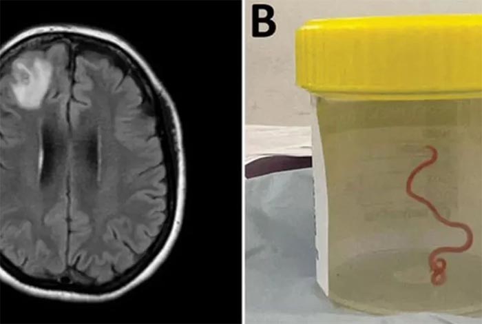  বিশ্বে এই প্রথম, মহিলার মস্তিষ্কে ৩ ইঞ্চি লম্বা জীবন্ত কৃমি