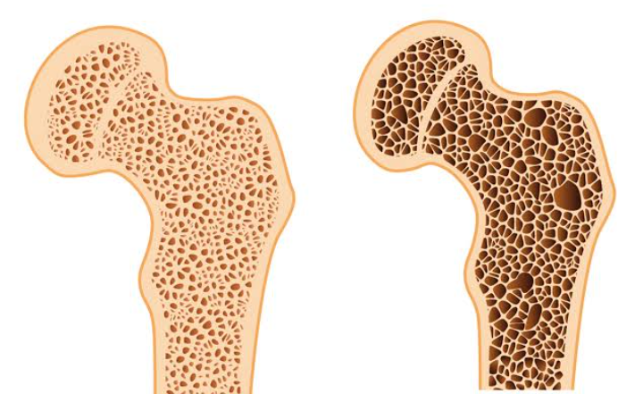  চল্লিশের পরেই কমতে পারে হাড়ের ঘনত্ব!!